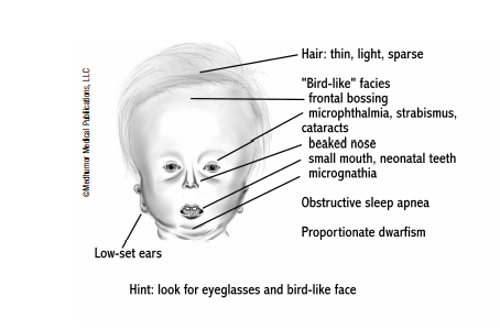 Hallermann-Streiff Syndrome - Pediatric Board Review